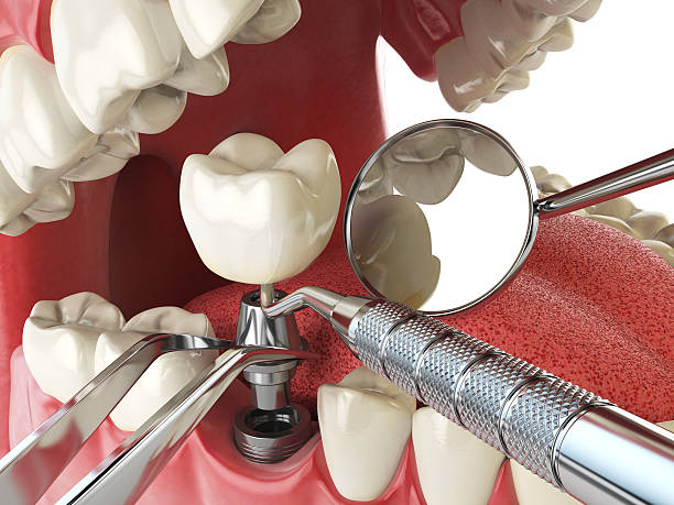 Best Emergency Wisdom Teeth Removal in Newburyport, MA