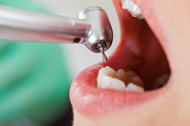 Best Urgent Care for Lost Fillings or Crowns in Newburyport, MA
